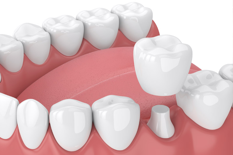 Dental Crowns in Kokomo