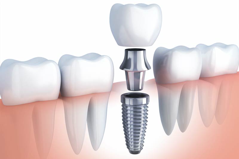 Single tooth Dental Implants in Kokomo