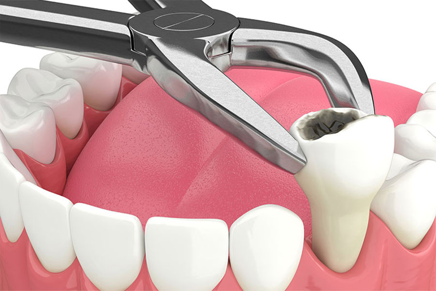 Tooth Extraction in Kokomo
