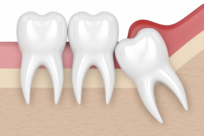 Tooth Extraction in Kokomo